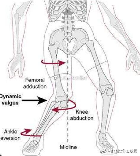 「动作修正」运动中出现膝外翻（膝内扣）的原因分析与解决方案