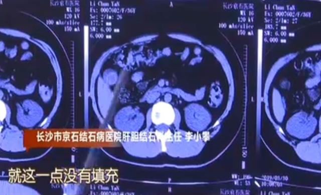 美女狂吃内脏结果悲剧了:体内塞满“话梅”被送医开刀